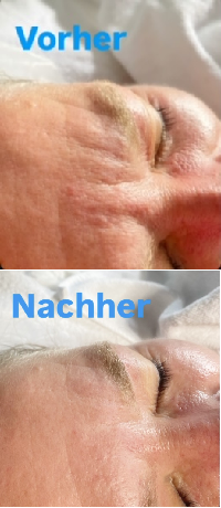 PRXvorher